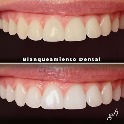 Blanqueamiento dental chica plus 2