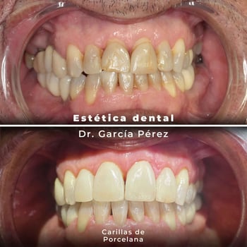 caso-real-de-carillas-de-porcelana-gh-clínica-dental-barrio-salamanca-madrid