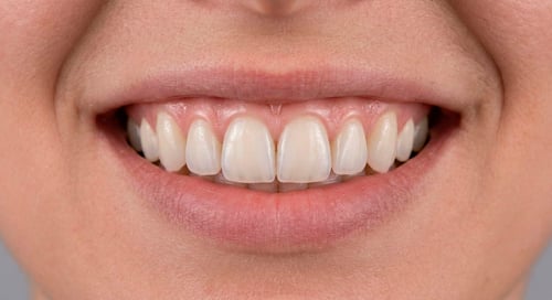 resultado-carillas-dentales-de-porcelana-madrid